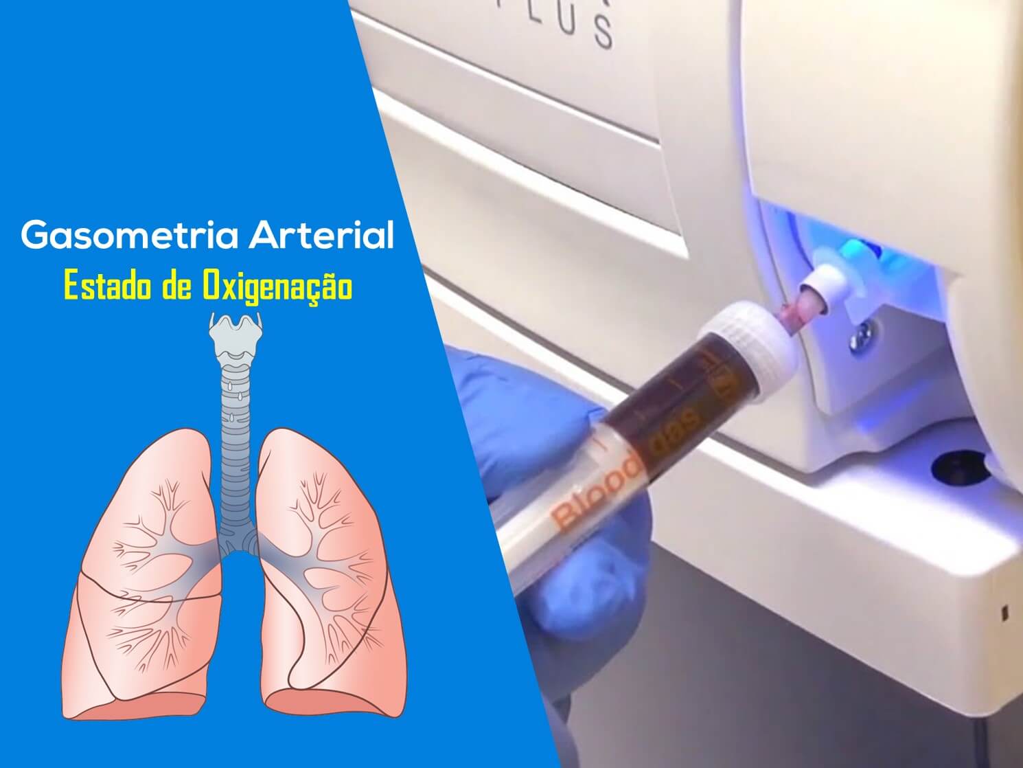 Interpretação da Gasometria Arterial. Estado de Oxigenação.