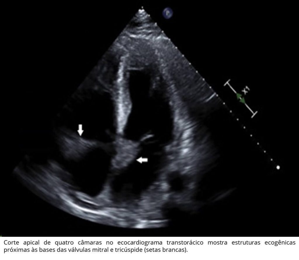 Qual melhor tratamento da hipertensão severa na gravidez? - CardioSite