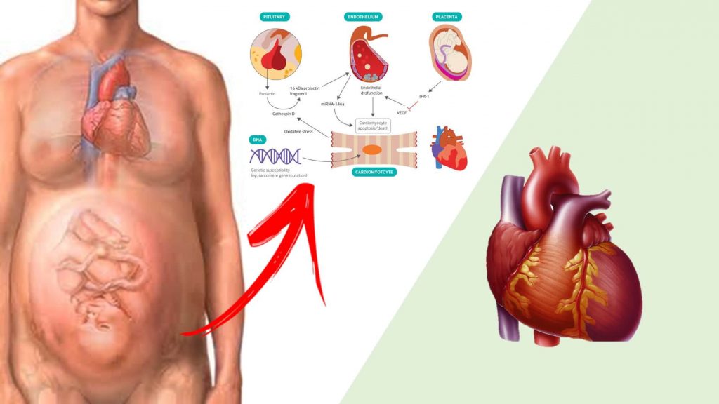 cardiomiopatia periparto